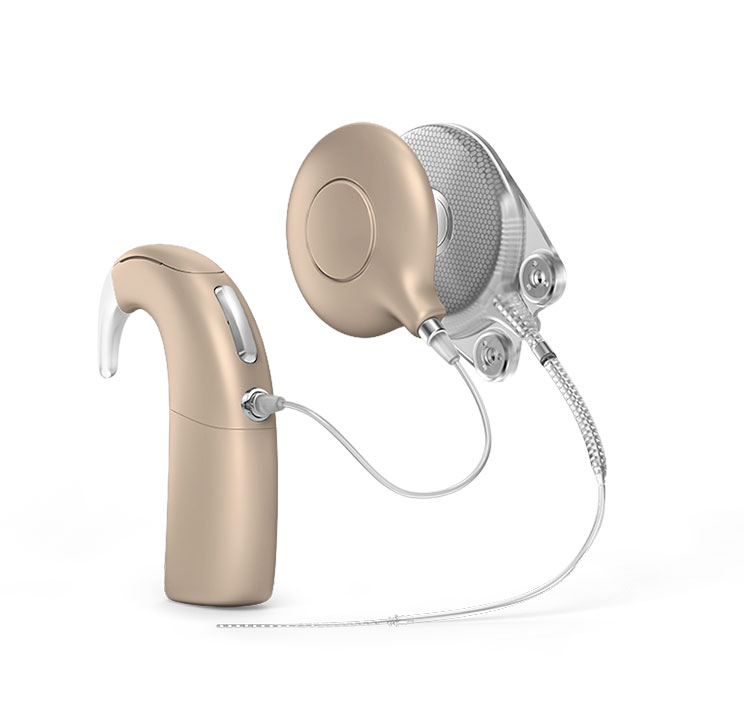 cochlear implant example