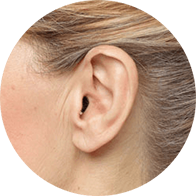 Image shows an Invisible hearing aids in ear