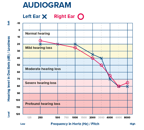 Degrees Of Hearing Loss Hearing Loss Chart Degrees Of Hearing Loss Hearing Loss Chart